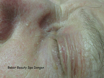 Milia / Gerstekorrel