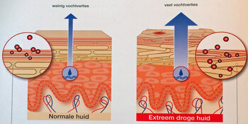 Heb ik een droge huid?